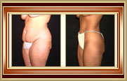 before and after tummytuck photo