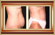 before and after tummytuck photo