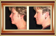 before and after facelift photo