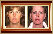before and after facelift photo