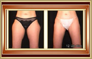 before and after liposuction photo