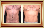 before and after liposuction photo